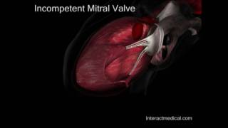 Mitral Valve normal and incompetent [upl. by Alohcin]