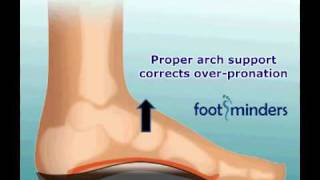 Foot Pain Due to Flat Feet and OverPronation An Easy Solution [upl. by Ahouh]