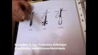 électrolyse epilation par la thermolyse explication [upl. by Wilkison524]