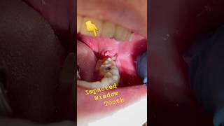 Impacted Wisdom Tooth should be removed [upl. by Boru]