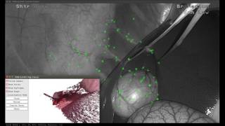 SLAM based Quasi Dense Reconstruction For Minimally Invasive Surgery Scenes Private Dataset [upl. by Ayortal]