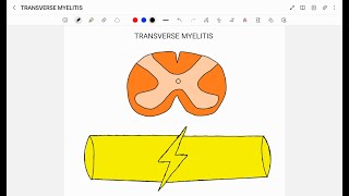 TRANSVERSE MYELITIS [upl. by Aridatha]