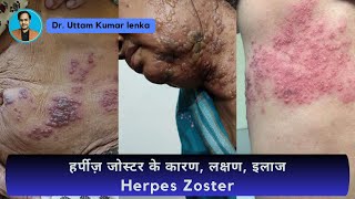 Herpes Zoster हर्पीज़ का इलाज  painful blisters on skin  pain after herpes  Dr Uttam Lenka [upl. by Eibber]