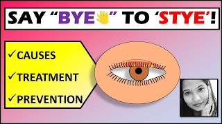 quotGoodbye Styequot  Stye Treatment amp Prevention  External Hordeolum [upl. by Eisiam]