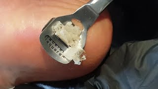 Pedicure  Pedicure At Home DIY Hard Dead Skin Removal [upl. by Eednus]