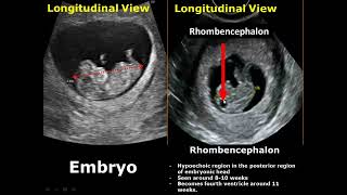 First Trimester amp Ectopic Pregnancy Ultrasound Image Appearances [upl. by Alexis]