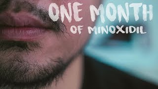 Minoxidil for Beard Growth 1 Month Vellus and Terminal Hairs [upl. by Agnizn]