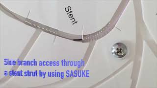 Angioplasty technique Side branch access by using SASUKE [upl. by Wilonah412]