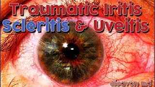 Cleavon MD  Traumatic Iritis Scleritis and Uveitis [upl. by Ellmyer390]