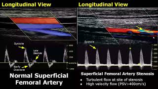 Femoral Artery Doppler Ultrasound Normal Vs Abnormal  StenosisOcclusionPseudoaneurysmAVF USG [upl. by Benjy]