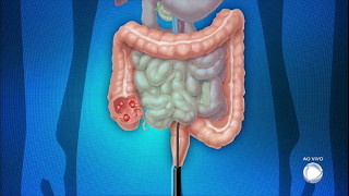 Você e o Doutor saiba tudo sobre os males do intestino [upl. by Lontson949]