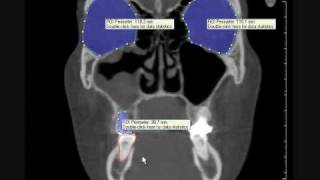 3D volume rendering DVT of female skull with maxillary sinusitis and dental cyst [upl. by Macintyre]