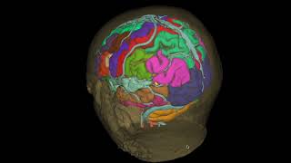 Cavernoma parietal [upl. by Suellen]