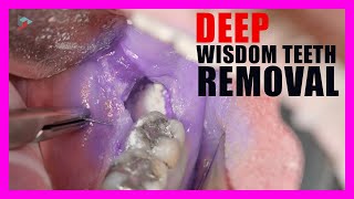 How To Safely and Quickly Have a Wisdom Tooth Extraction [upl. by Chenay53]