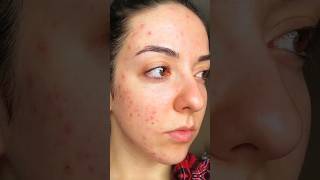 Remove Acne In 10 Days  shorts shortsfeed trending [upl. by Eltsirc]