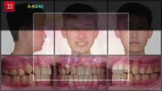 Treatment of impacted maxillary canine with Invisalign｜【Chris Chang Ortho】CC767 [upl. by Gard561]