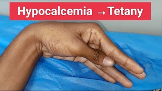 Hypocalcemia and Tetany [upl. by Booma]