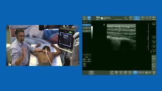 Erector Spine Plane ESP block  Live Demo [upl. by Llehcear522]