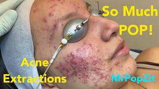 So much pop Acne extractions on severe inflammatory acne Multiple blackheads and whiteheads [upl. by Janeczka601]