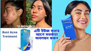 রাতারাতি ব্রন দূর করার জেল কতটা কার্যকরী Differin Gel Acne Treatment  khadija begum [upl. by Keri]