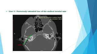 Radiological classification of Anatomical Variation of Sigmoid Sinus [upl. by Atiuqa669]