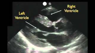 Cardiac Ultrasound  Parasternal Long Axis  Part 1  Sonosite Inc [upl. by Strohben]