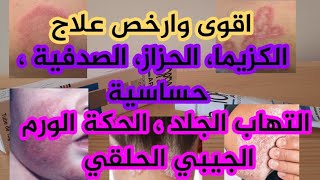 ارخص مرهم لعلاج كزيما ، صدفية، حساسية الجلد، حزاز ، التهاب الجلد، حكة غير طفيلية طوبسين Topsyne APG [upl. by Diane960]