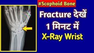 Fracture Scaphoid Bone  XRay Wrist  UdayXRay [upl. by Nysila]