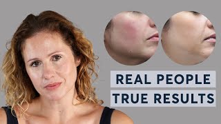 ProfhiloHydro Deluxe  Real People True Results [upl. by Ahsinav301]