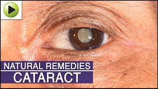 Cataract  Natural Ayurvedic Home Remedies [upl. by Svensen]