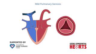 Pulmonary Stenosis [upl. by Adnaral536]