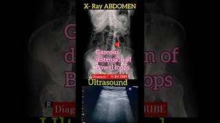 Gaseous distension of bowel loops  X  Ray Abdomen amp USS Abdomen  Diagnosis  Radiology [upl. by Balas]