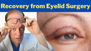 How to Recover from a Blepharoplasty  Plastic Surgeons Guidance on Eyelid Surgery Recovery [upl. by Akenahs668]