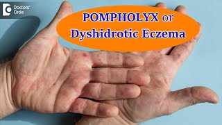 DYSHIDROTIC ECZEMA OR POMPHOLYX CausesSymptoms amp Treatment  Dr Aruna Prasad  Doctors Circle [upl. by Netsyrc]