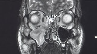 Normal dental procedure leads to emergency brain surgery [upl. by Hazem]