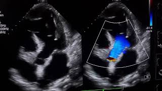 RWMAModerate LV DysfunctionTrace pericardial effusionpleural effusion cardioheartcondition [upl. by Chainey]