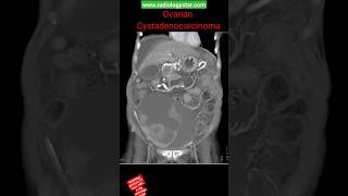 Ovarian Cystadenocarcinoma shorts radiology youtubeshorts [upl. by Svoboda]