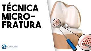 LESÃO CARTILAGINOSA Tratamento através da técnica da MICROFRATURA [upl. by Yoong190]