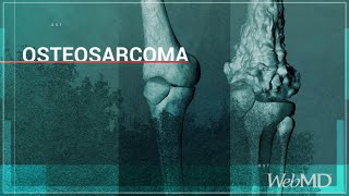 Basics Osteosarcoma  WebMD [upl. by Acsicnarf]