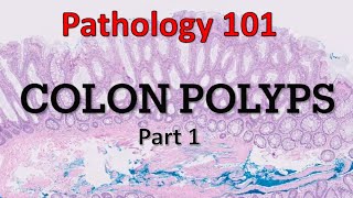 Colon Polyps  Part 1 Pathology 101 [upl. by Ahsim]