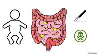 Necrotizing Enterocolitis [upl. by Acissj119]