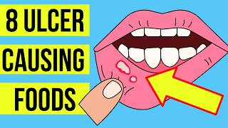 8 FOODS and DRINKS causing MOUTH ULCERS Canker sore  Plus treatment [upl. by Yadnil]