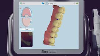 iTero® Scanner Tutorial Scanning and Charting for a Single Unit Prep [upl. by Rutter]