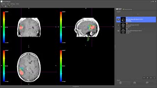 BrainMagix 20 PETMRI Fusion in a Brain Tumor [upl. by Ross]