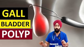 Gall Bladder Polyp  Cure amp Risk of Cancer  DrEducation Hindi Eng [upl. by Ayn]