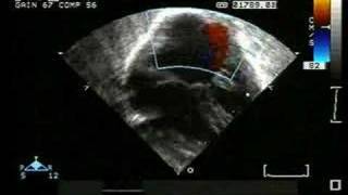 AV Canal Defect with Single Atrium and PDA [upl. by Zitvaa]