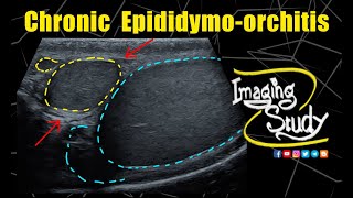 Chronic Epididymoorchitis  Ultrasound  Case 328 [upl. by Cora645]