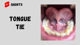 TongueTie  Ankyloglossia [upl. by Ettenyar]