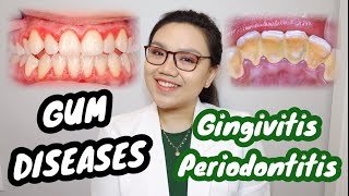 GUM DISEASE Gingivitis and Periodontitis 🦷 Namamagang gilagid masama ba  Dr Bianca Beley [upl. by Dolloff242]