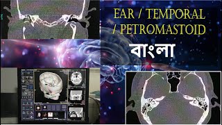 How to do CT Scan of Temporal bone Ear or Mastoid  basicradiology [upl. by Tyne]